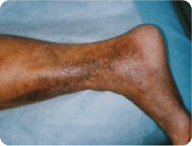 Advanced-Venous Spider and Varicose Vein Treatment