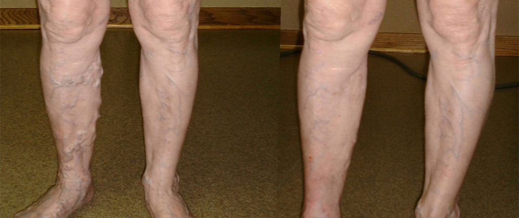 Before and after image of a patient's legs treated with Endovenous laser treatment