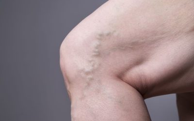 Leaky Valve and Varicose Veins at Groin and Knee