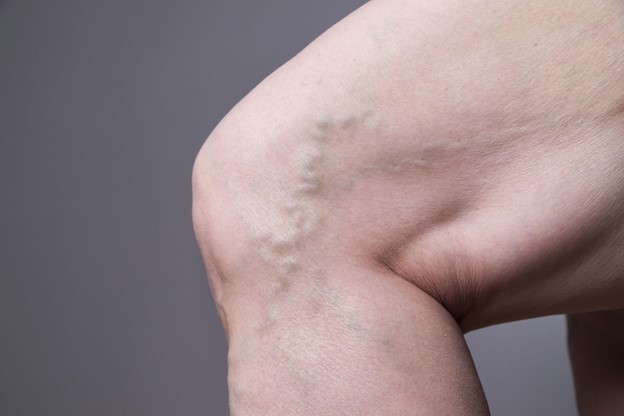 Leaky Valve and Varicose Veins at Groin and Knee