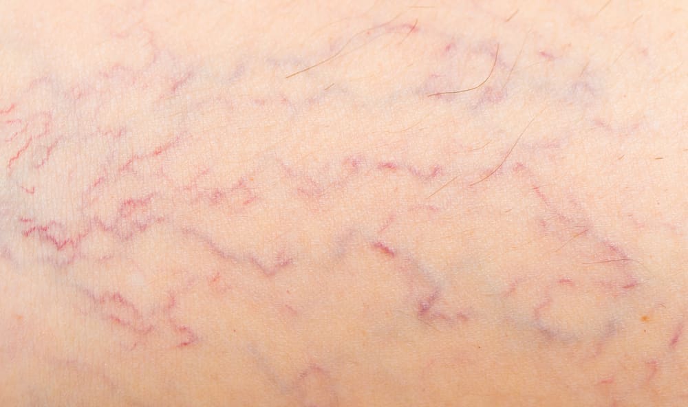varicose veins on the skin