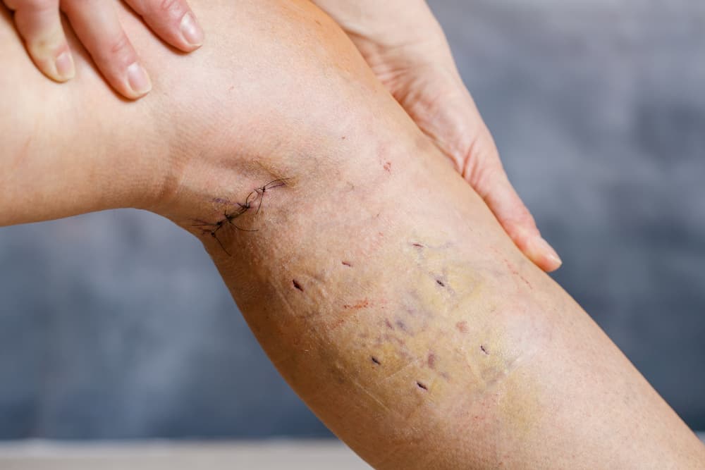 Patients leg with visible surgical stitches after varicose vein surgery