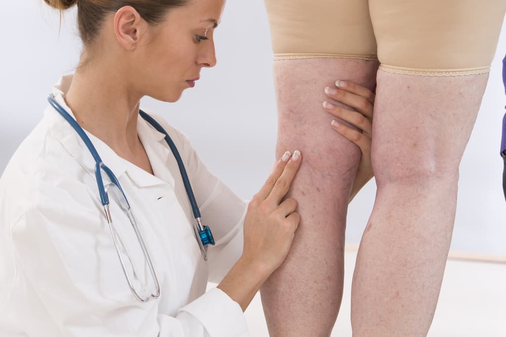 Debunking the Myths Around Varicose Veins