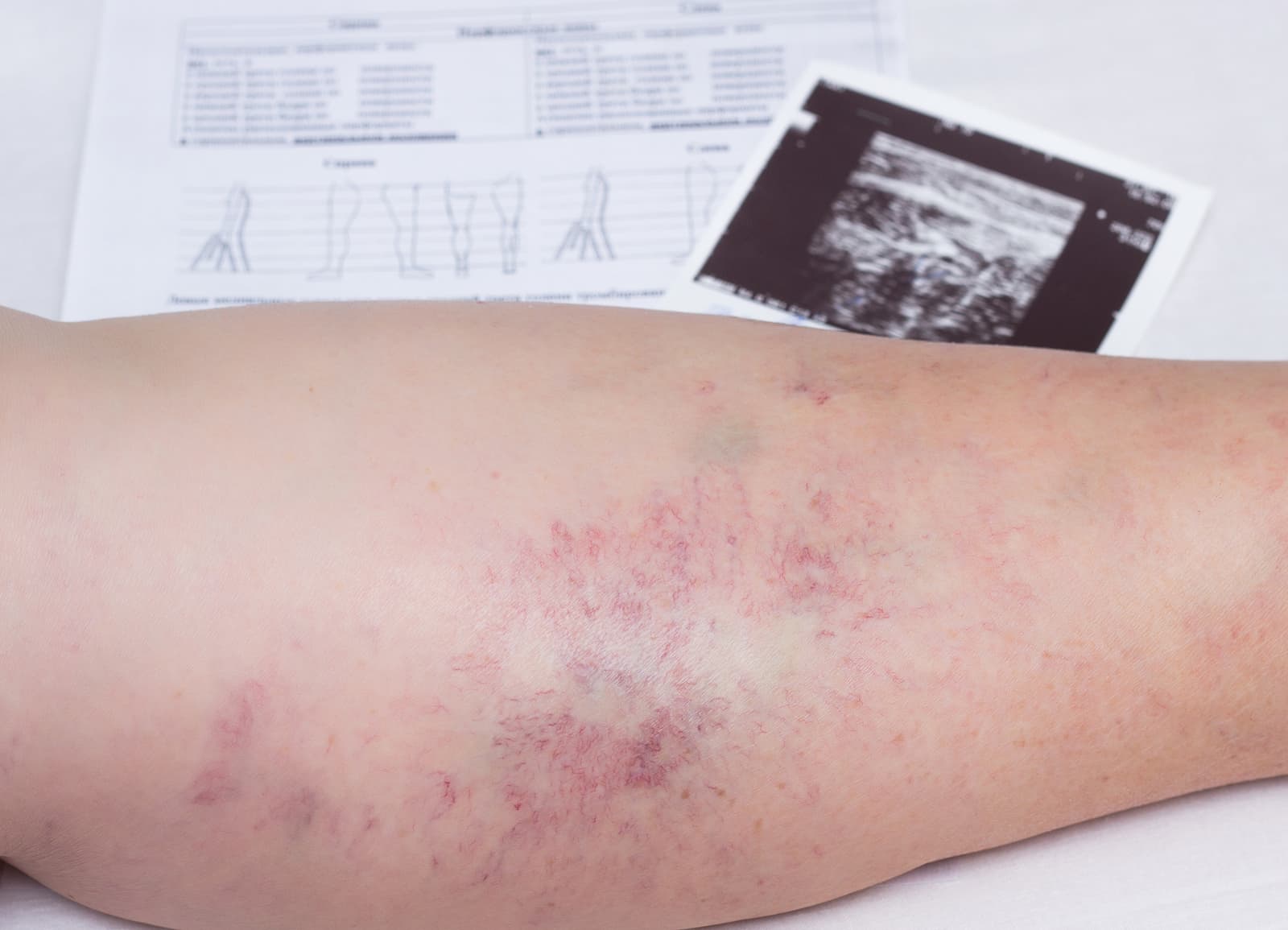 Close up image of patients leg having varicose veins with ultrasound examination documents
