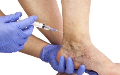 The Best Treatment for Spider Veins