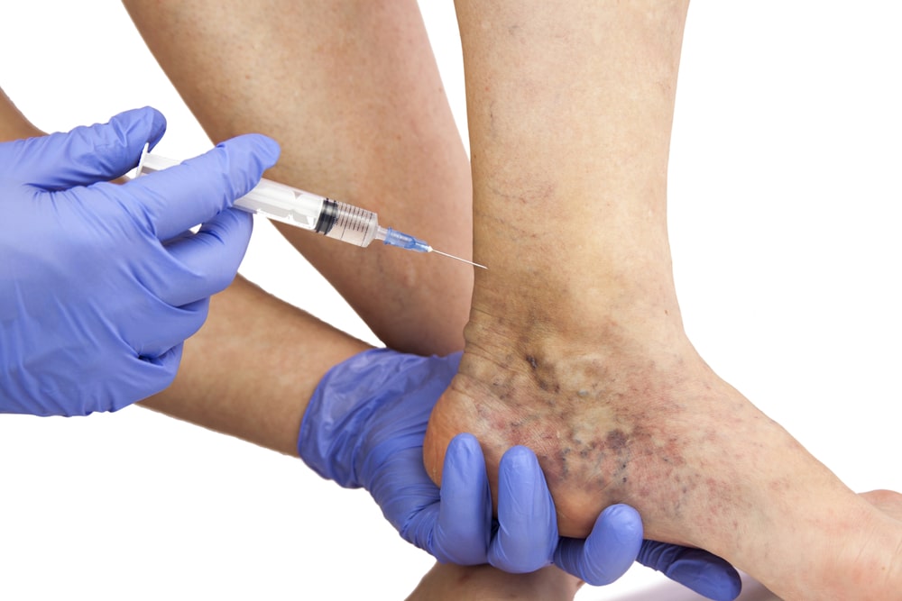 The Best Treatment for Spider Veins