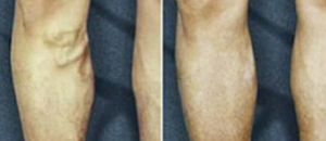 Comprehensive Varicose Veins Project in Australia