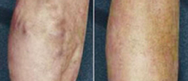 Varicose and Spider Vein Removal