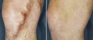 Varicose Veins