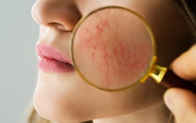 7 Steps to Avoid Spider Veins on Your Face