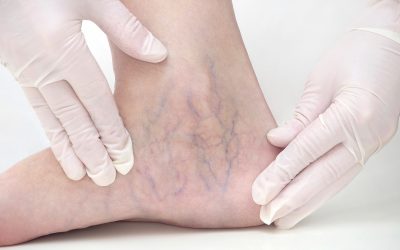 Aftercare restrictions for sclerotherapy