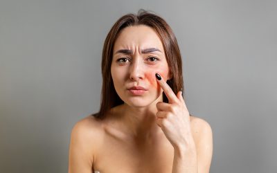 How Rosacea Symptoms Change Over Time