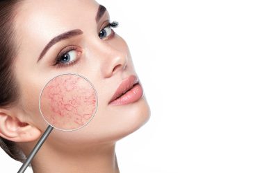 The Difference between Spider Veins and Rosacea