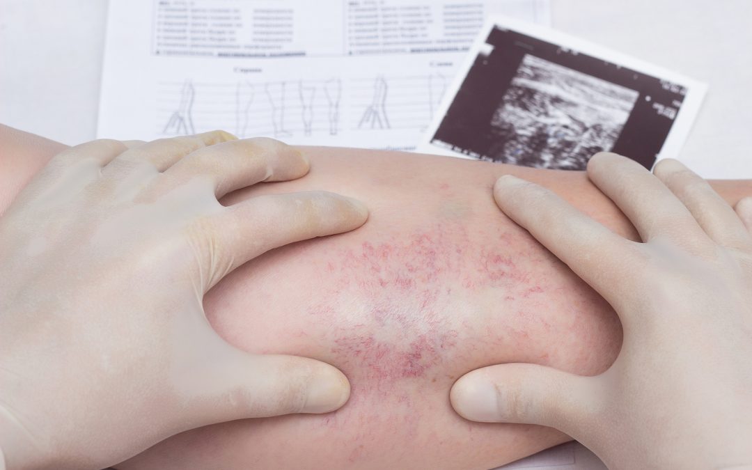 The Wavelengths of Varicose Vein Treatments