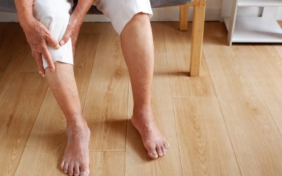 Treating Family History of Varicose Veins in Australia