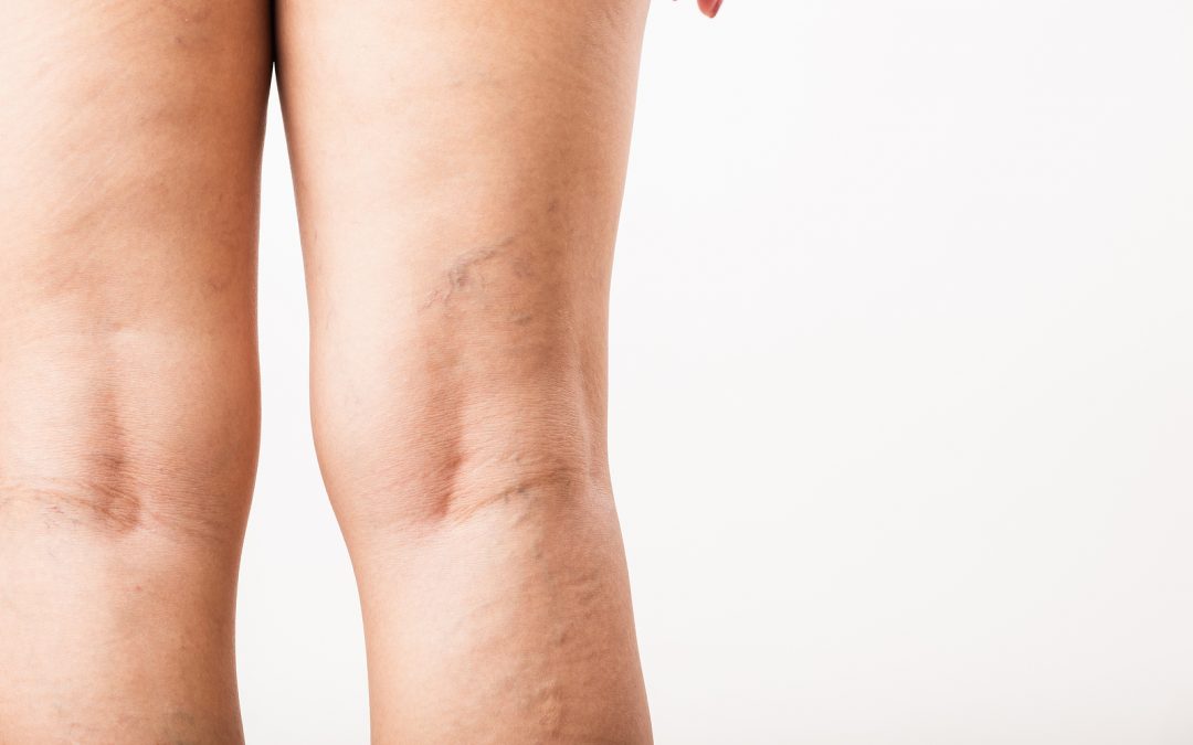 Close up image of women having spider vein on her leg