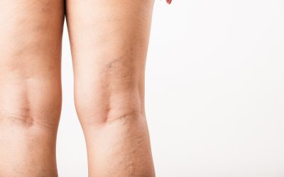 Will my spider veins get worse?