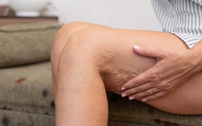 Best Sitting Position for Varicose Veins
