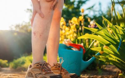 Early Stage Varicose Veins Symptoms