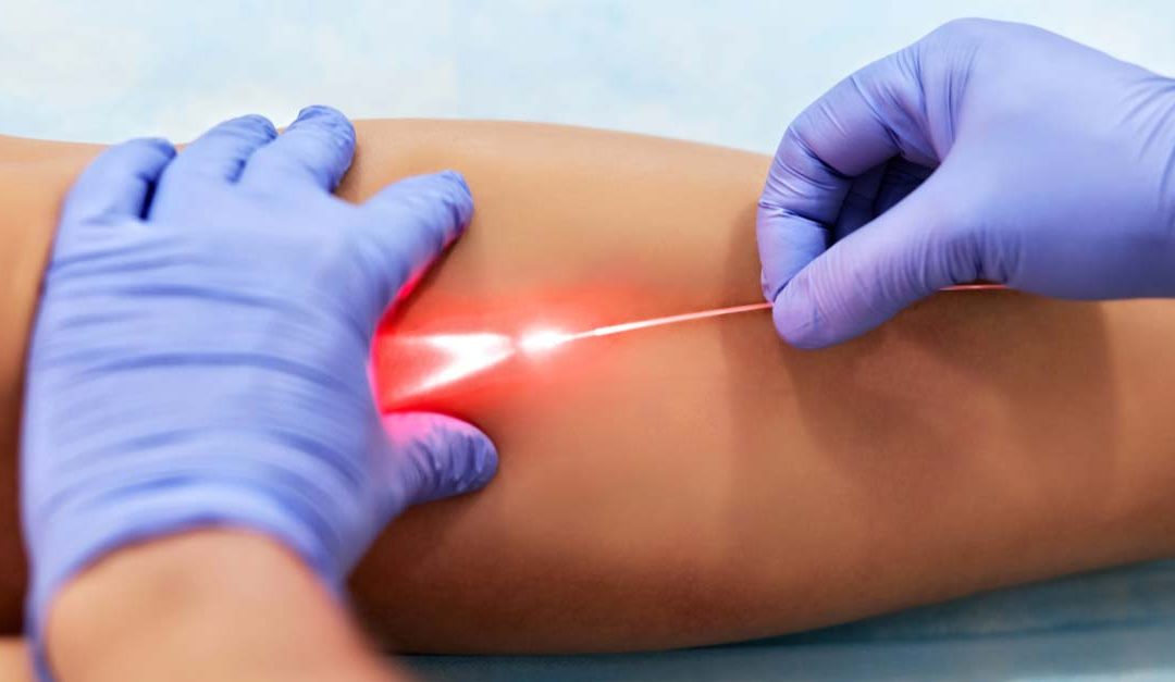 What to Expect from EVLT at Melbourne Vein Clinic