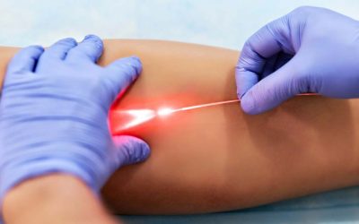 What to Expect from EVLT at Melbourne Vein Clinic