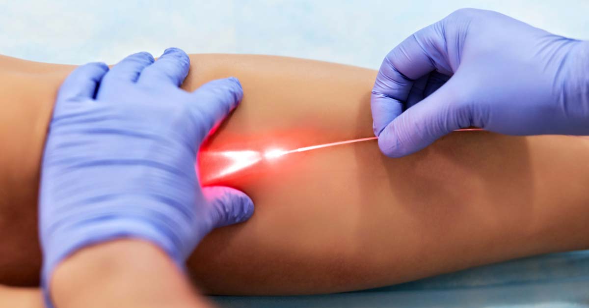 Varicose Vein Myths by Vein Care in Melbourne