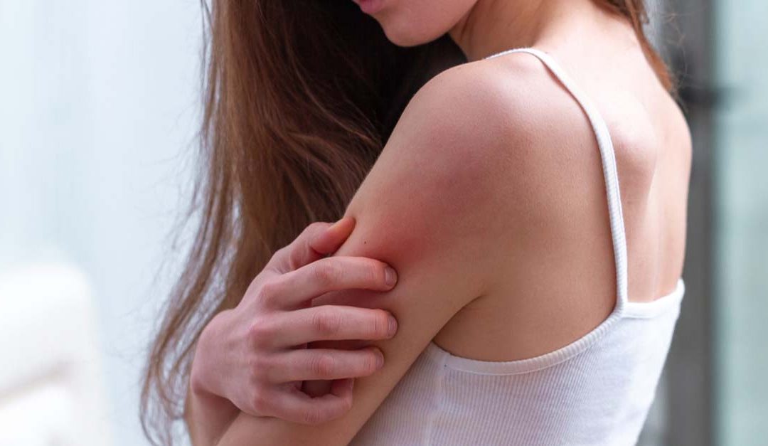 Possible Health Issues with Spider Veins on Arms