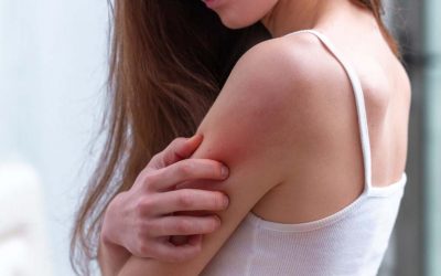 Possible Health Issues with Spider Veins on Arms