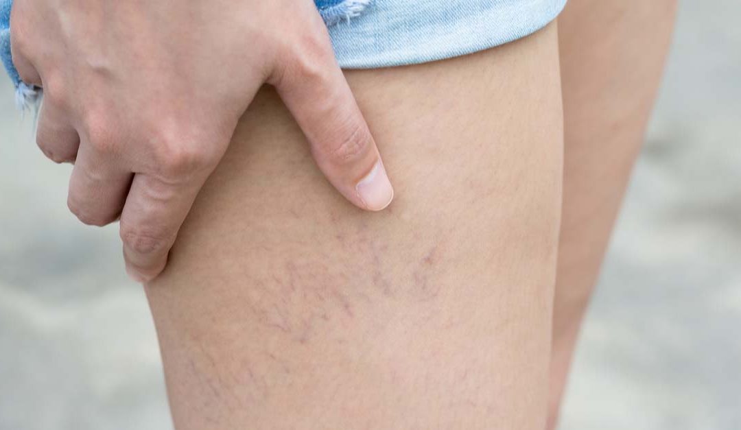 How a Healthy Lifestyle Can Prevent Varicose Veins