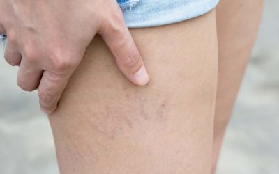 How a Healthy Lifestyle Can Prevent Varicose Veins