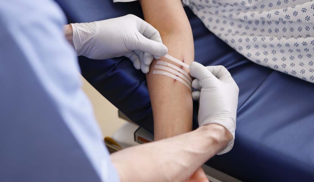 Ambulatory Phlebectomy for Varicose Veins Arms