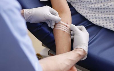 Ambulatory Phlebectomy for Varicose Veins Arms