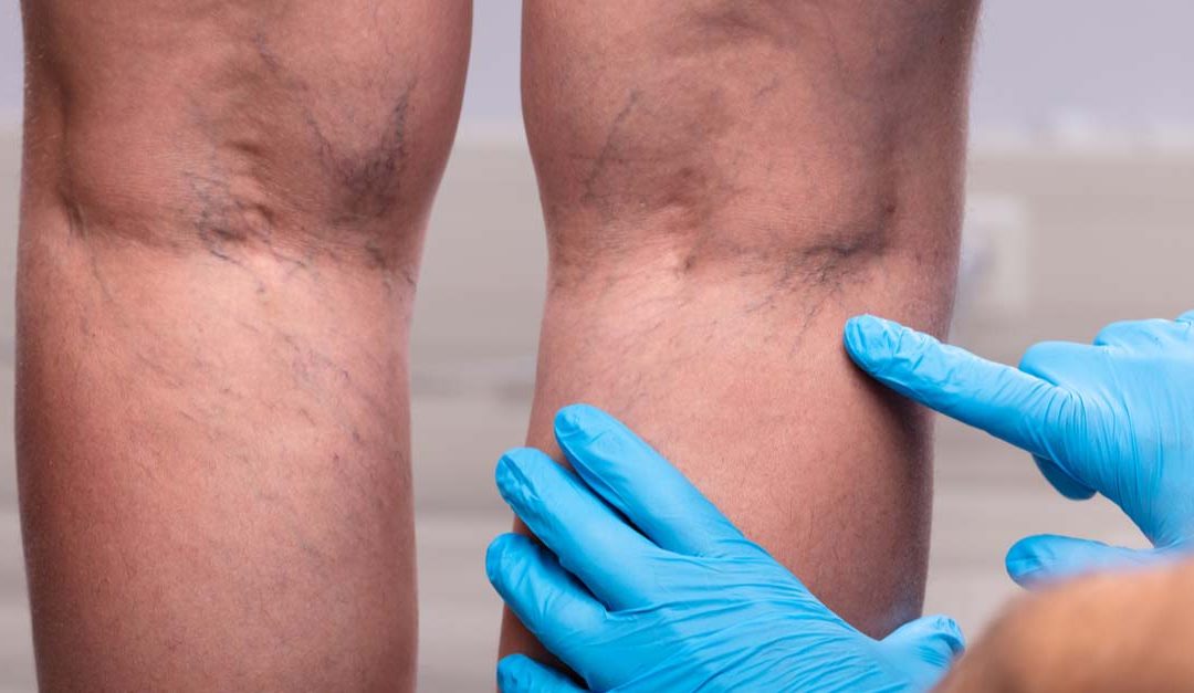 Medic With Blue Latex Surgical Gloves Touching Varicose Veins On Patient's Leg