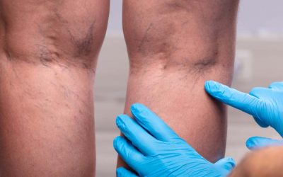 4 Questions for Your Vein Doctor in Melbourne