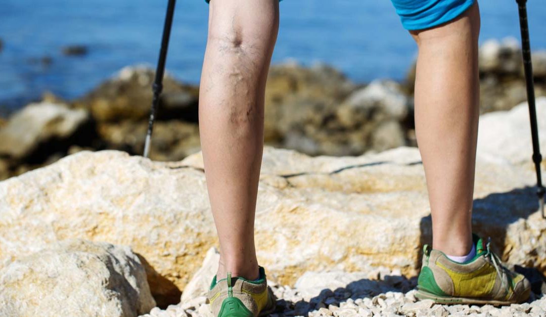 Reticular Veins vs. Varicose Veins: What You Should Know