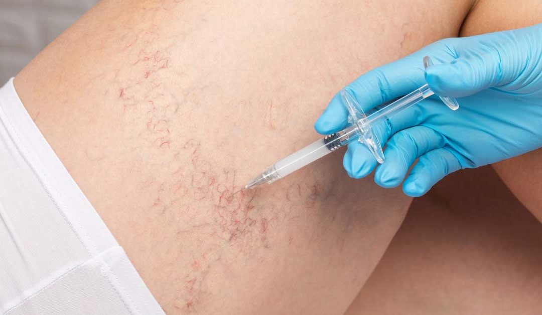 How to Prepare for Sclerotherapy in Melbourne