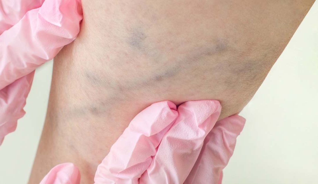 What to Expect from Your Vein Clinic Consultation