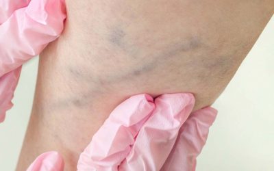 What to Expect from Your Vein Clinic Consultation