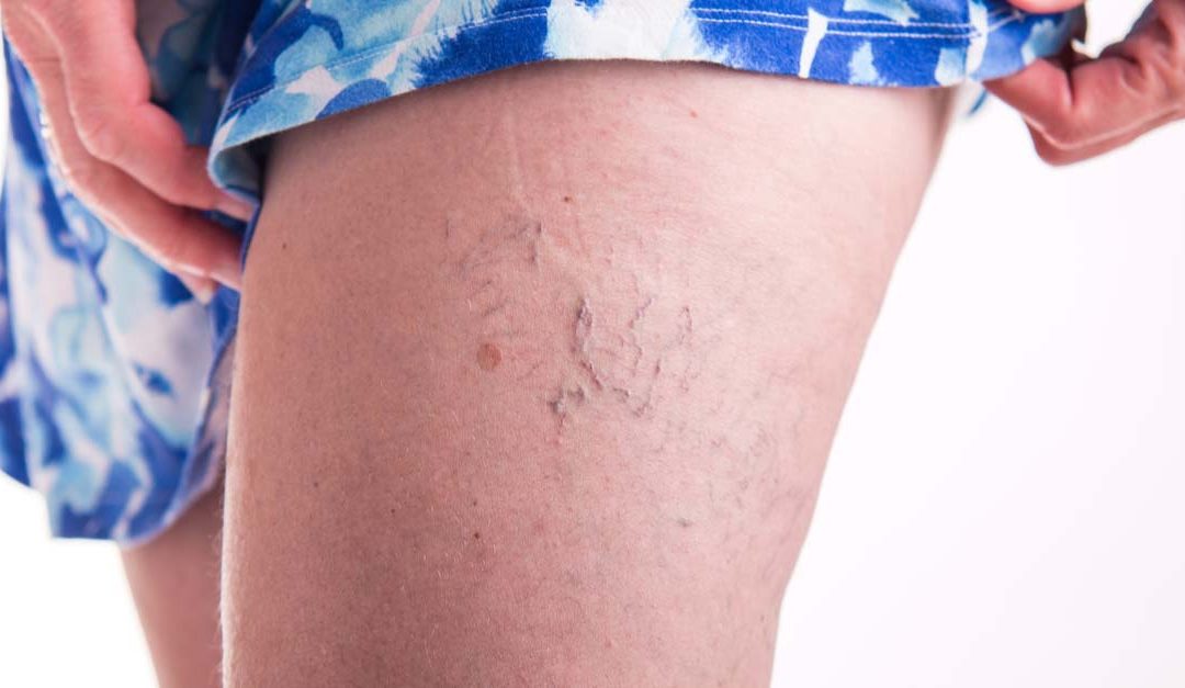 Preparing for Spider Vein Treatment in Melbourne