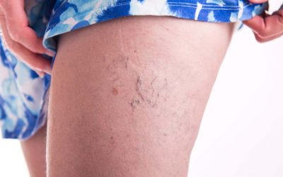 Preparing for Spider Vein Treatment in Melbourne