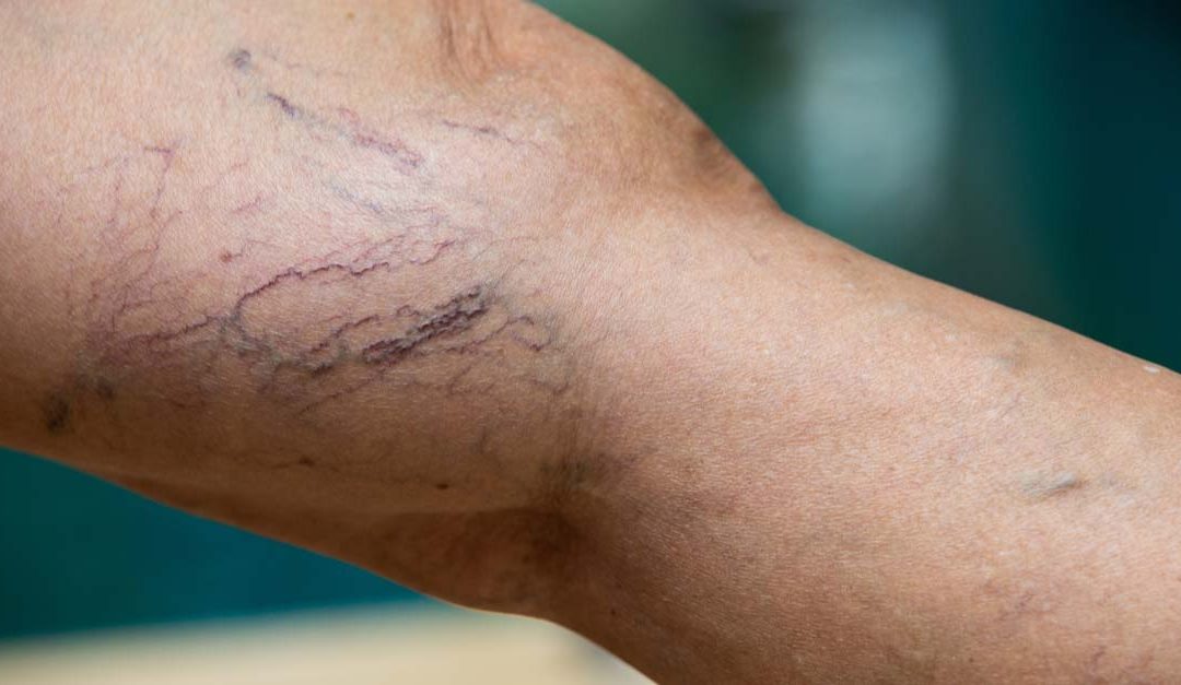 Is Varicose Vein Treatment Medicare Covered in Australia?