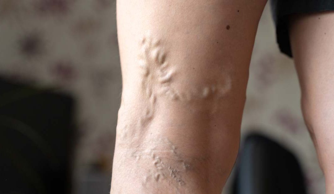 When You Should Worry About Varicose Veins