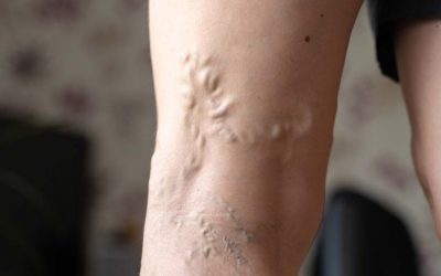 When You Should Worry About Varicose Veins