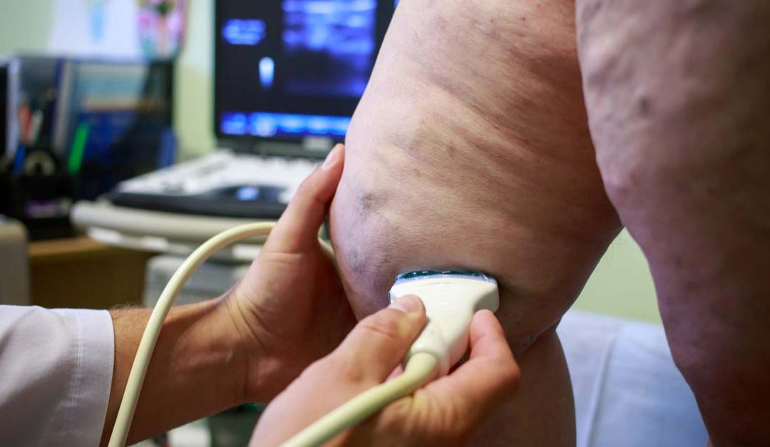 Perks of Ultrasound Guided Sclerotherapy