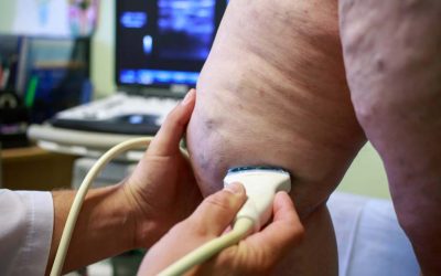 Perks of Ultrasound Guided Sclerotherapy