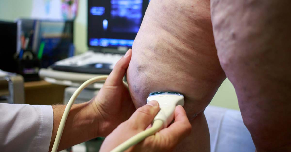 Varicose Vein Myths by Vein Care Varicose Vein Myths by Vein Care in Melbourne