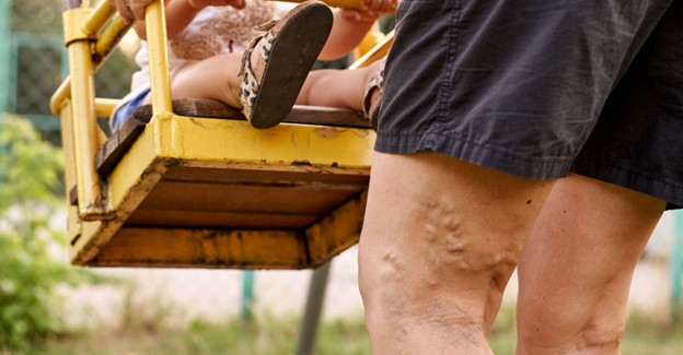 What Role Does Genetics Play on Vein Health Melbourne