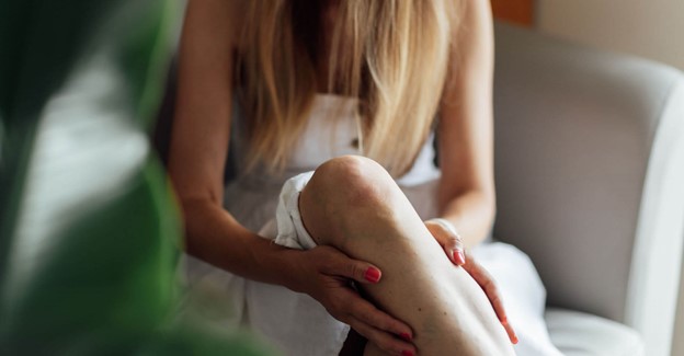 The Psychological Impact of Varicose Veins, Melbourne