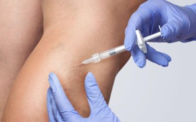 Pros and Cons of Sclerotherapy for Veins in Melbourne