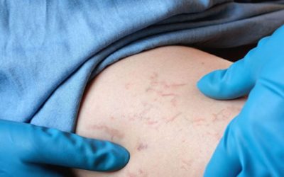 Prevention of Spider Veins During Pregnancy, Melbourne